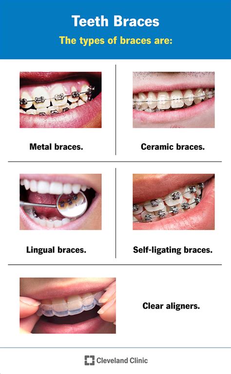 can you bond bracket to metal band|A Guide to the Different Types of Metal Braces .